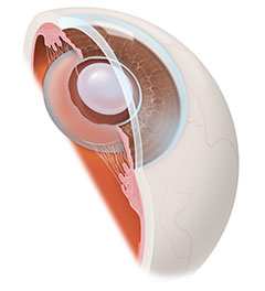 Intraocular Lens Flemington NJ | Clinton NJ